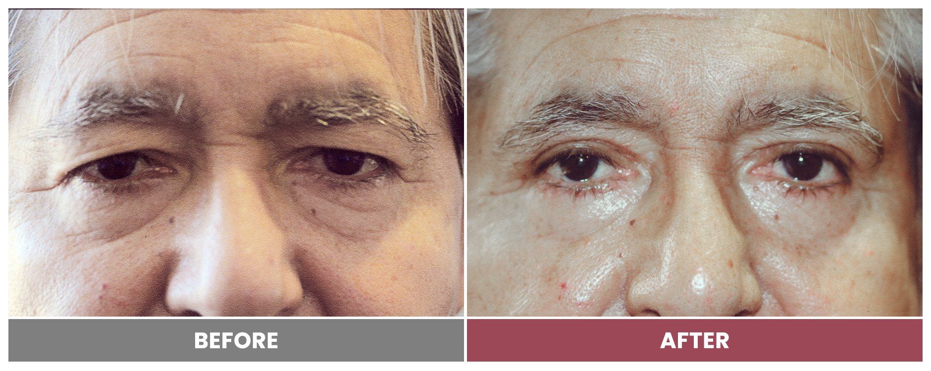 Upper Blepharoplasty - Case 1